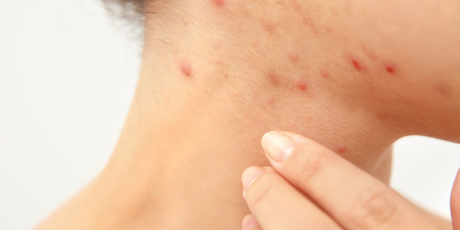 Hormonal Acne... What The Flip Is It?